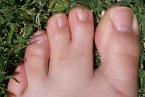 Лечение синдактилии в Германии