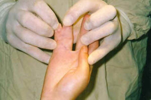 Хирургическое вмешательство