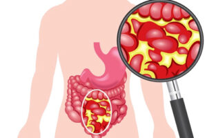 Лечение перитонита в Германии