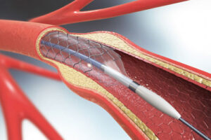 Эндоваскулярный койлинг