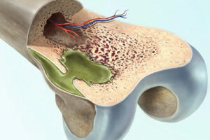 Лечение остеомиелита в Германии
