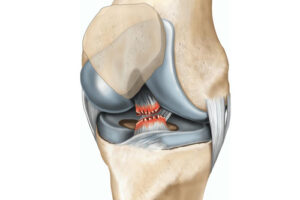Лечение повреждения крестообразных связок коленного сустава в Германии