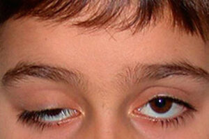 Лечение птоза верхнего века в Германии