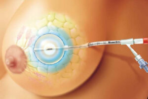 Инъекционные методы