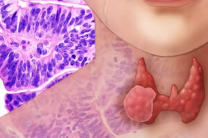 Лечение медуллярного рака в Турции