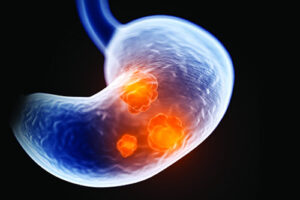 Лечение слизистого рака в Турции