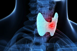 Лечение папиллярного инвазивного рака в Турции