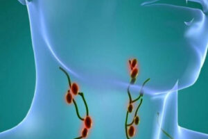 Лечение лимфопластической лимфомы в Турции