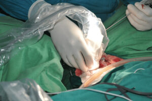 Хирургическое удаление опухоли