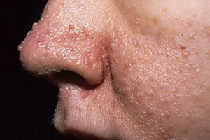 Лечение туберозного склероза в Турции