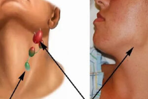 Лечение лимфомы в Германии