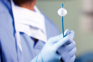 Криоабляция