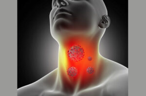 Лечение рака горла в Израиле