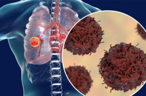 Лечение рака легких в Турции