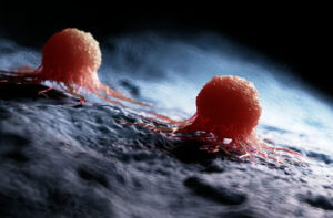 Лечение карциномы в Германии