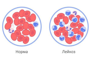 Лечение лейкоза в Германии