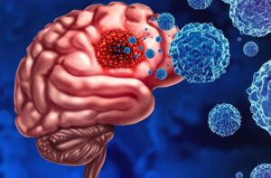 Лечение олигодендроглиомы в Германии