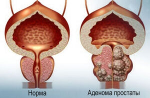 Лечение аденомы простаты за рубежом