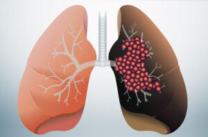 Лечение рака легких в Испании