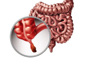 Лечение рака аппендикса в Турции