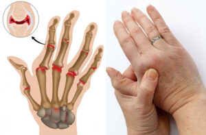 Лечение суставов в Германии