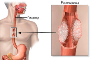 Лечение рака пищевода в Израиле