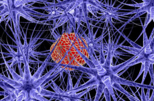 Лечение шванномы в Испании