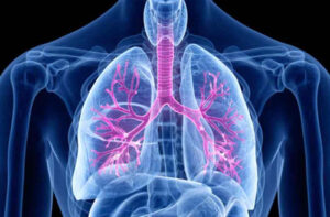 Лечение рака бронхов в Турции