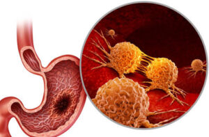 Лечение аденокарциномы желудка в Турции