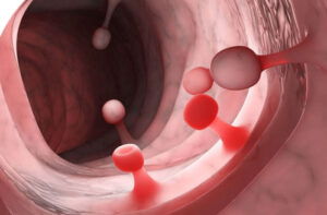 Лечение полипоза прямой кишки в Германии