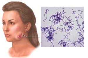 Лечение актиномикоза в Турции