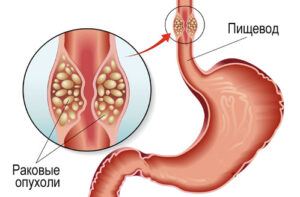 Лечение рака пищевода в США