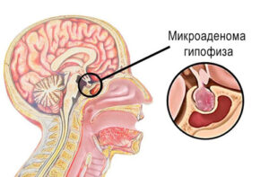 Лечение микроаденомы гипофиза в Германии