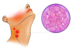 Лечение лимфосаркомы в Турции