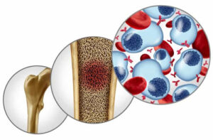 Лечение миеломы в Турции