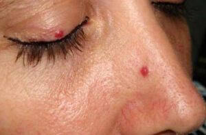 Лечение гемангиомы в Испании