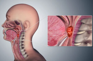 Лечение рака гортани в Турции