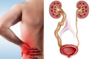 Лечение мегауретера в Турции