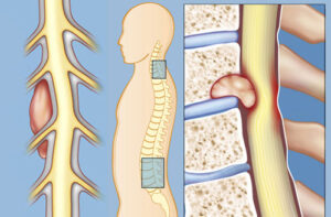 Лечение опухолей позвоночника в США