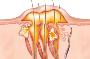 Лечение гидраденита в Израиле