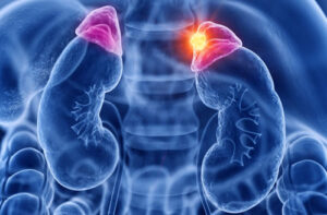 Лечение рака надпочечников в Турции